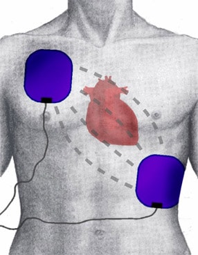 AED of defibrillator kopen